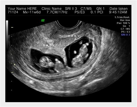He said He couldnt dream up a better report (yay). . Fake twin ultrasound